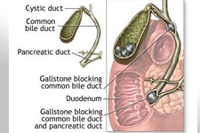 Gallbladder stones blocking the Gallbladder